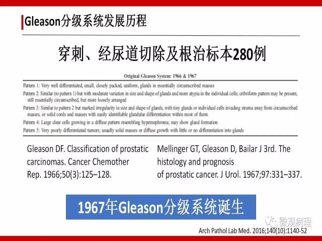 前列腺癌Gleason分级系统的前世今生