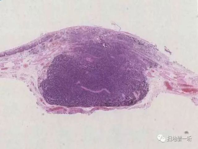 病理解读：神经内分泌癌伴扁平上皮癌