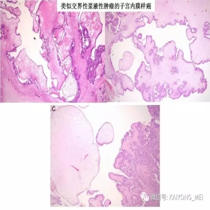 卵巢癌的病理诊断新进展（二）
