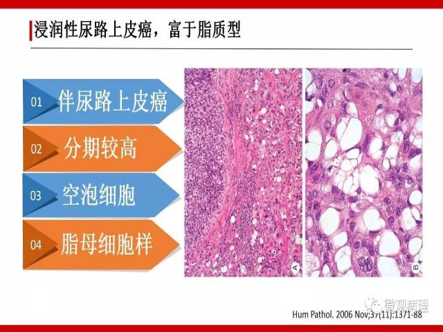 泌尿课程/浸润性尿路上皮癌病理学类型