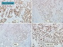 乳腺病理-乳腺癌-乳腺癌分子分型