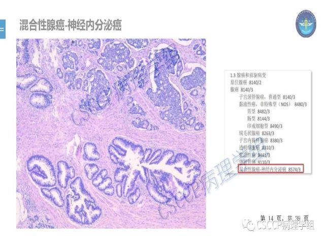 黄文亭 张询：宫颈腺癌分类介绍