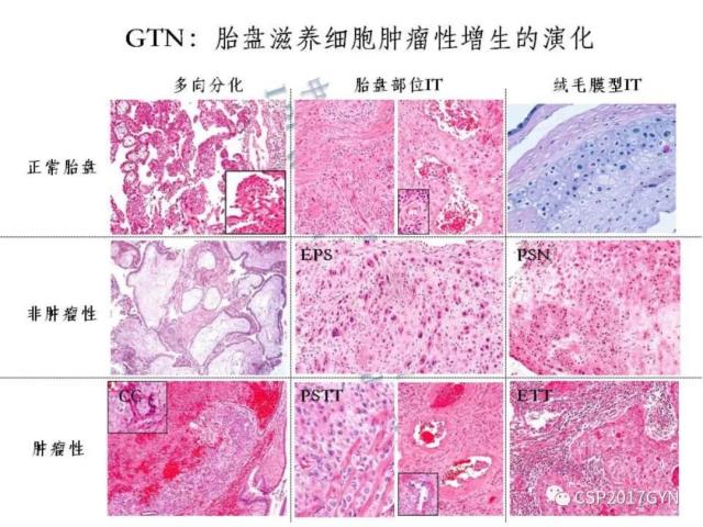 妊娠滋养细胞肿瘤的临床病理学进展