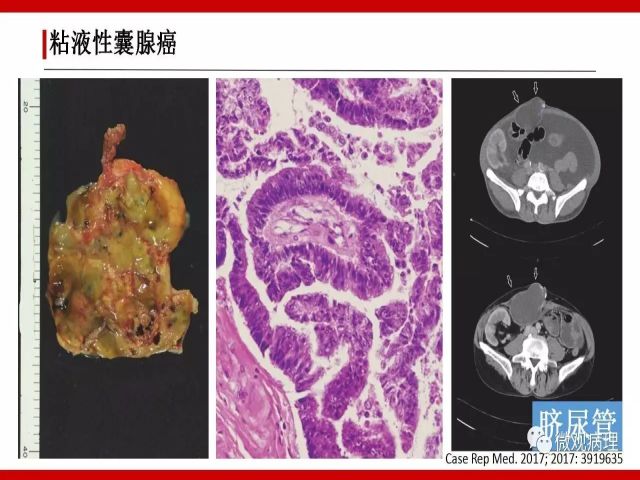 泌尿课程/尿路腺样病变的诊断要点