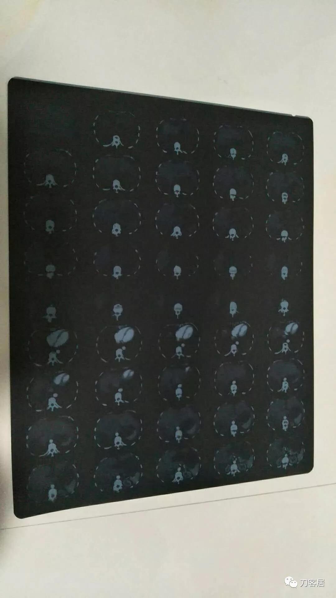 医生及患者通用:如何用手机翻拍X线片,磁共振片子,CT片子进行网络求医、病例讨论及保留资料 医生及患者通用:如何用手机翻拍X线片,磁共振片子,CT片子进行网络求医、病例讨论及保留资料