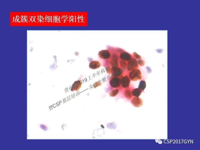 中华病理学会基层培训遵义站讲座（二）——宫颈细胞学诊断中陷阱与筛查进展