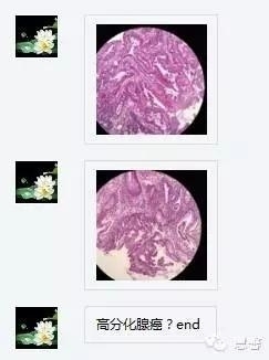 结、直肠管绒毛状腺瘤-高级别病变诊断等相关问题2（悄悄分享、孔祥田(Max)*Roswell*老师讲解）