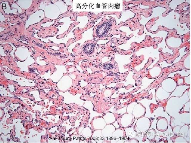 乳腺梭形细胞病变的病理诊断及进展（二）