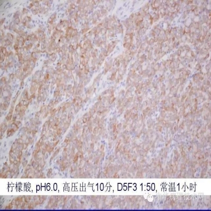 《常规免疫组化初筛ALK阳性非小细胞肺癌专家共识》技术部分解读