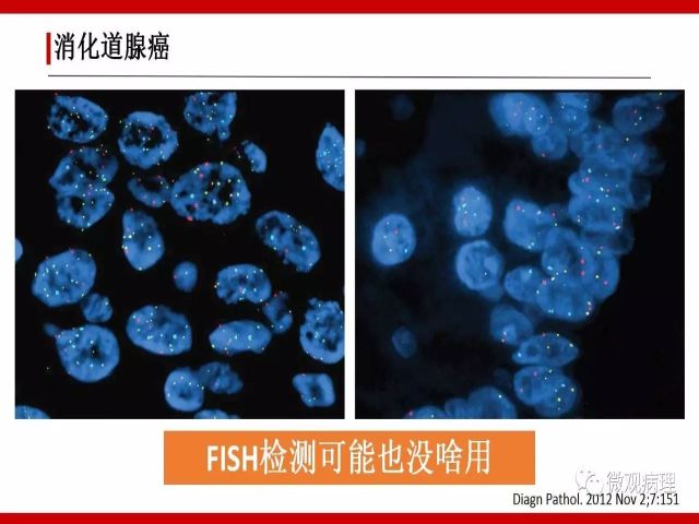 泌尿课程/尿路腺样病变的诊断要点
