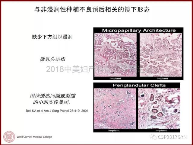 非粘液性卵巢肿瘤的诊断挑战