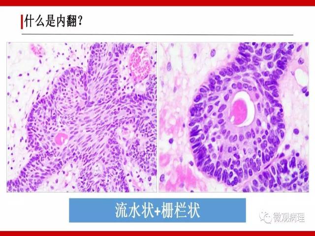 泌尿课程/尿路上皮病变的基本生长方式