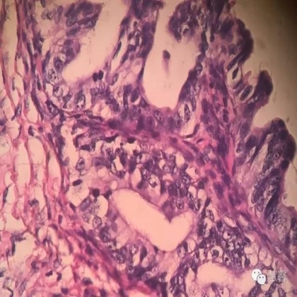 交界性黏液性囊腺瘤？癌？（魏娉分享，刘从容老师讲解）