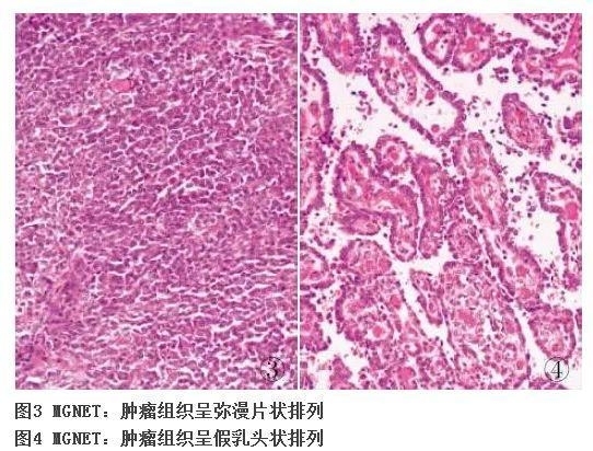 新近认识的胃肠道间叶性肿瘤