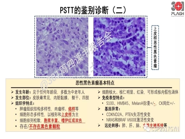 中间型滋养细胞肿瘤的诊断及鉴别诊断