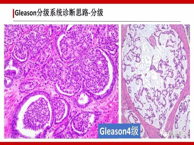 前列腺癌Gleason分级系统的前世今生