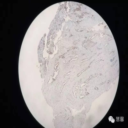 子宫腺肉瘤【吴梅娟】分享；【刘从容】老师讲解）