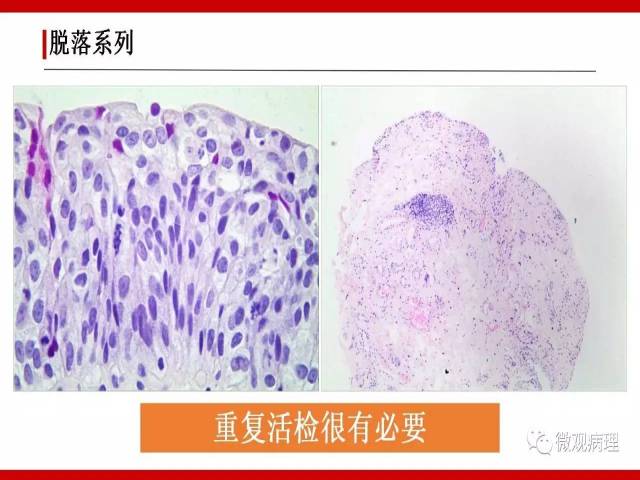 泌尿课程/非浸润性尿路上皮病变诊断的一些困惑