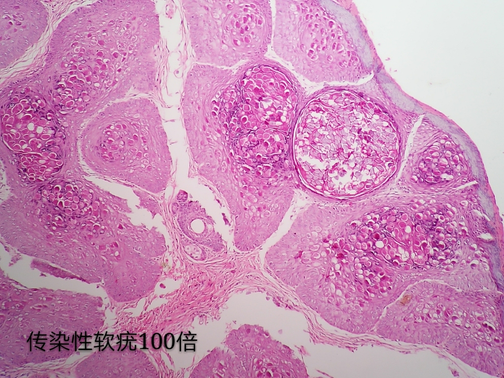 病理科工作札记（三十七）传染性软疣