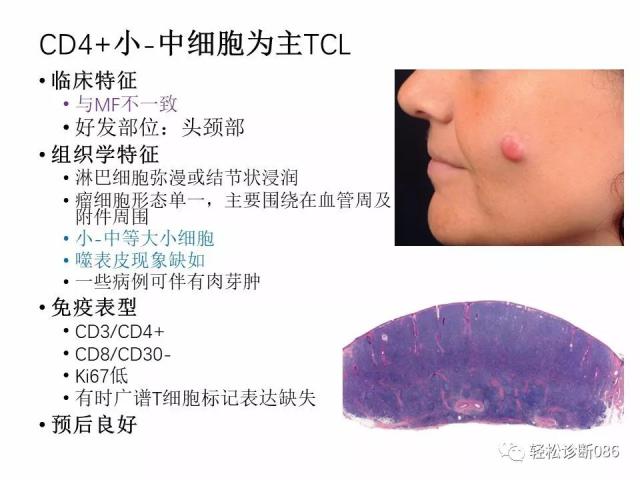 皮肤T细胞淋巴瘤
