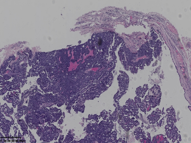 这个甲状腺肿瘤怎么看？