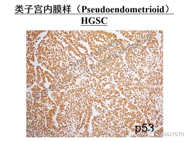 中华病理学会基层培训遵义站讲座（一）——卵巢和输卵管浆液性肿瘤的诊断和鉴别诊断