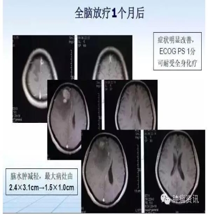 中日韩个体化诊疗案例大赛经典赏析之二——TKI治疗耐药二次活检发现SCLC转化临床病例