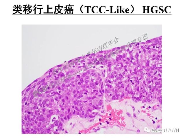 中华病理学会基层培训遵义站讲座（一）——卵巢和输卵管浆液性肿瘤的诊断和鉴别诊断