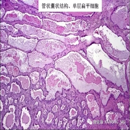 卵巢癌的病理诊断新进展（三）