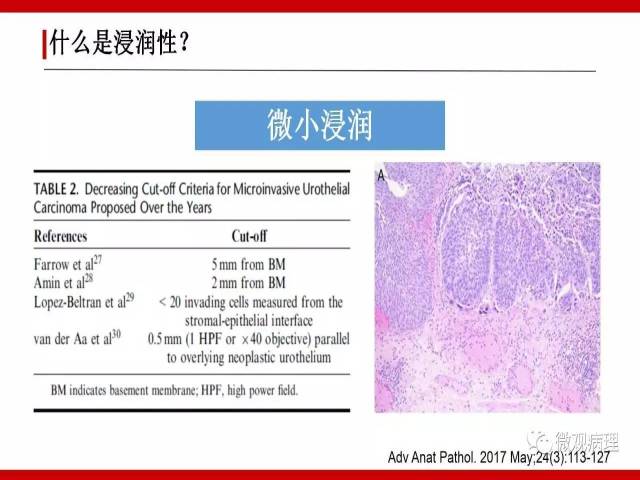 泌尿课程/浸润性尿路上皮癌病理学类型