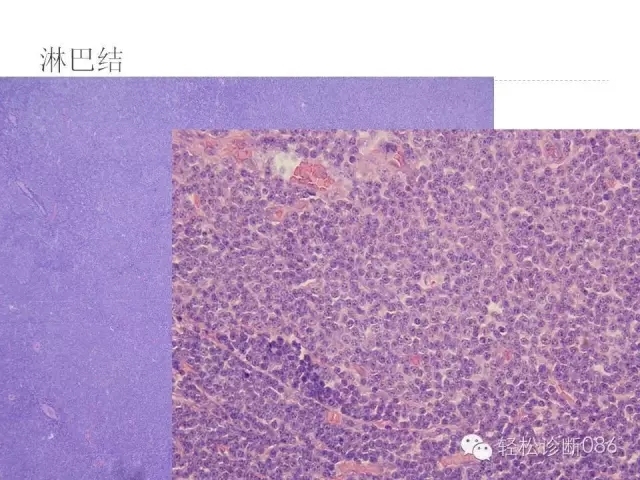 慢性淋巴细胞性白血病