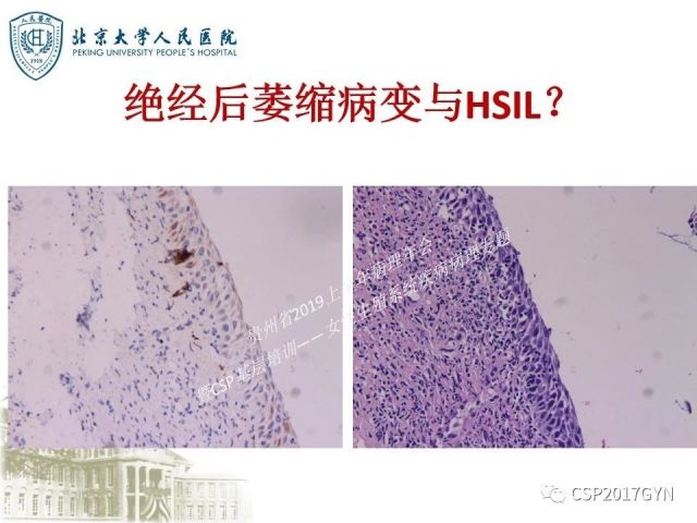 中华病理学会基层培训遵义站讲座（三）——宫颈鳞状上皮病变的病理诊断与鉴别诊断