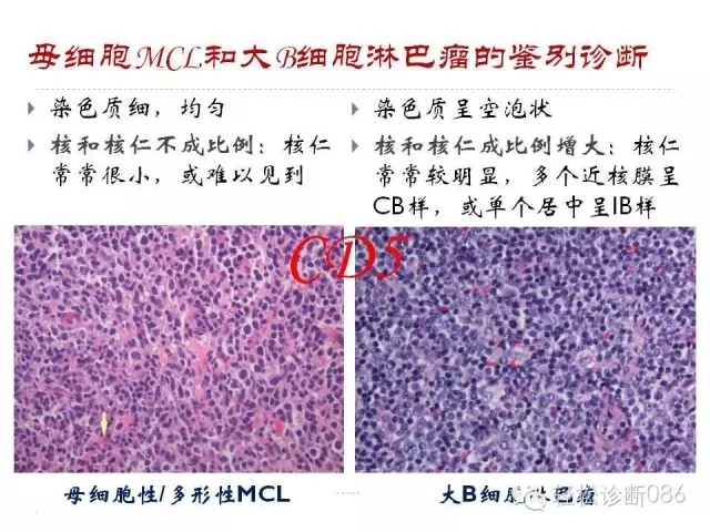 关于套细胞淋巴瘤的总结课件