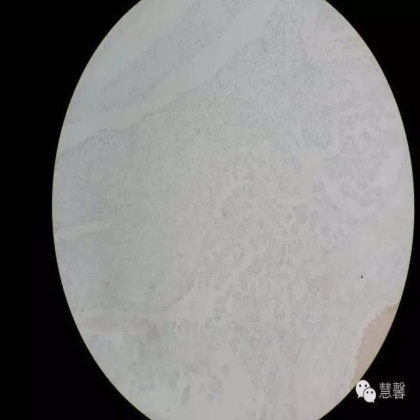 透明细胞乳头状肾细胞癌？TFE3 Traslocation Carcinoma？（赵洋分享，孔祥田(Max)*NM老师讲解）