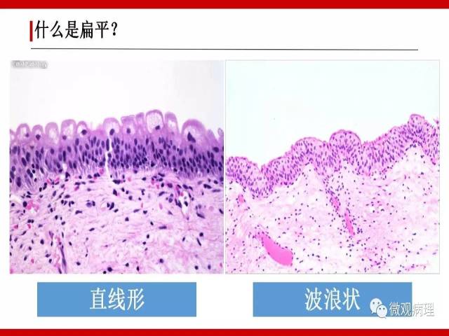 泌尿课程/尿路上皮病变的基本生长方式