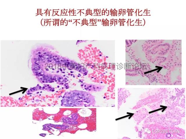 子宫内膜假肿瘤性病变及类似癌样病变