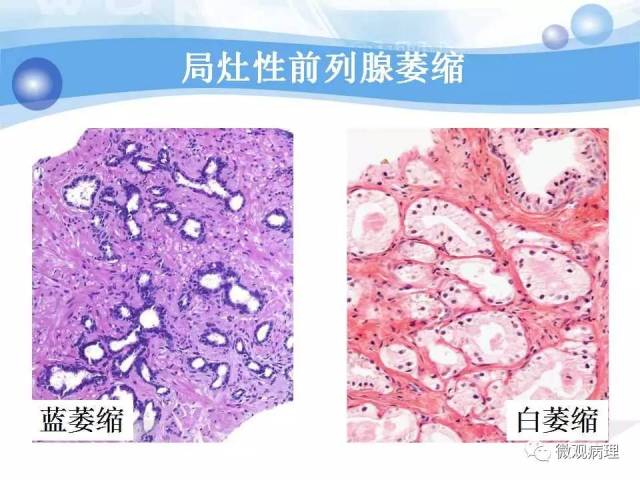 泌尿课程/局灶性前列腺萎缩