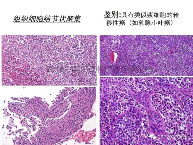 子宫内膜假肿瘤性病变及类似癌样病变