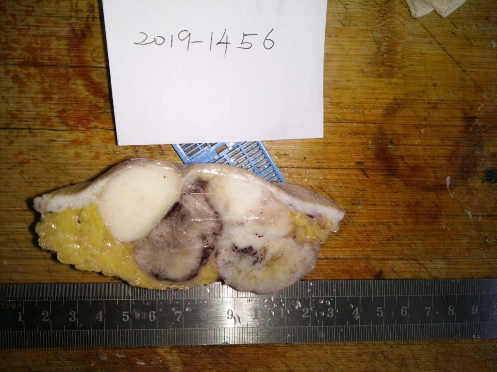 病理科工作札记（二十九）隆突性纤维肉瘤