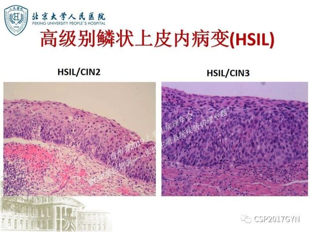 中华病理学会基层培训遵义站讲座（三）——宫颈鳞状上皮病变的病理诊断与鉴别诊断