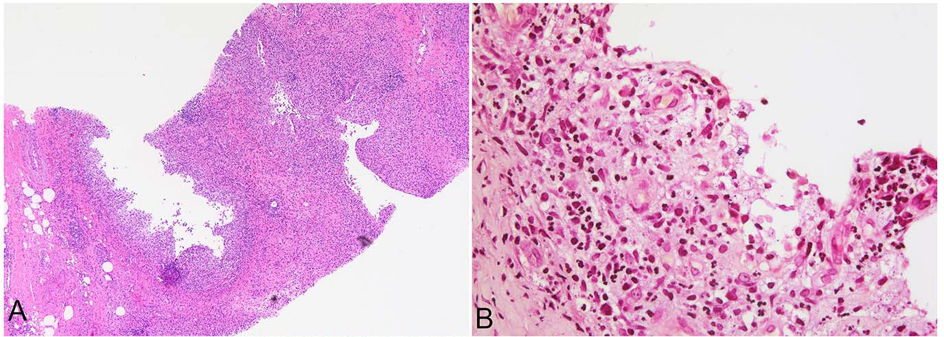 读文献，学病理-妊娠及哺乳相关的乳腺病变（一）