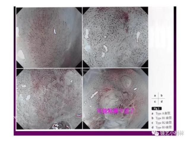 上消化道早癌病理的学习心得体会（附胃牵手癌的病例特点文献学习）
