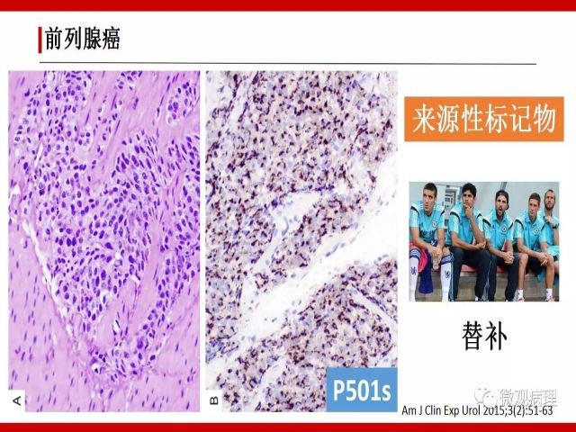 泌尿课程/尿路腺样病变的诊断要点