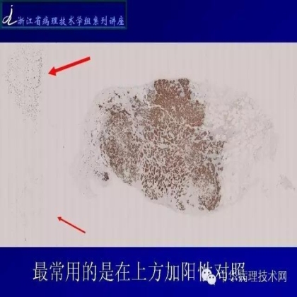 《常规免疫组化初筛ALK阳性非小细胞肺癌专家共识》技术部分解读