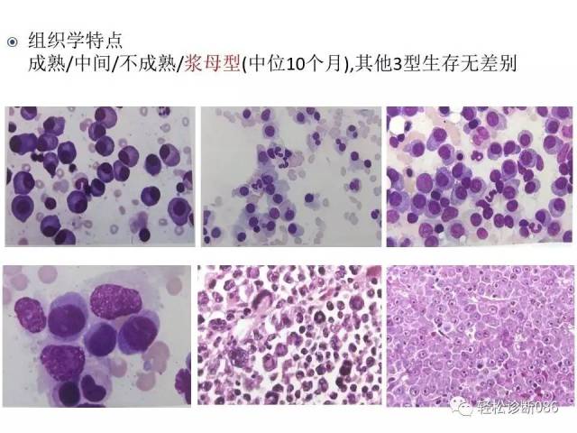 浆细胞相关肿瘤的病理诊断及鉴别诊断