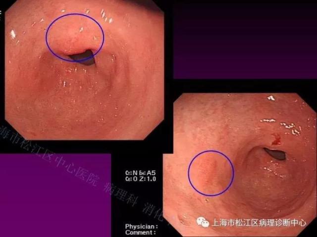 上消化道低级别上皮内瘤变的那些事