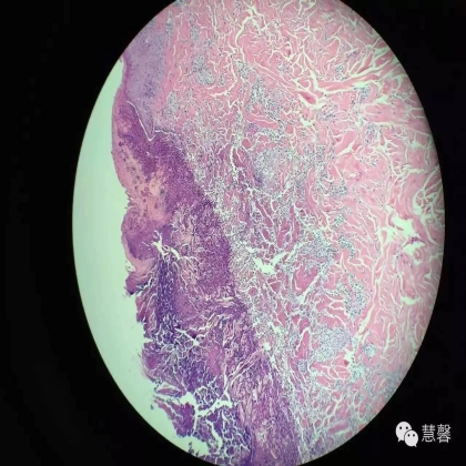 Acquired perforating dermatosis（孔祥田(Max)*Roswell*NM]分享及讲解）