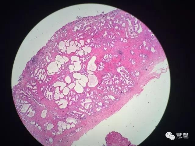 关于前列腺增生及PIN相关问题（张睿病例分享，孔祥田(Max)*Roswell*NM]老师讲解）