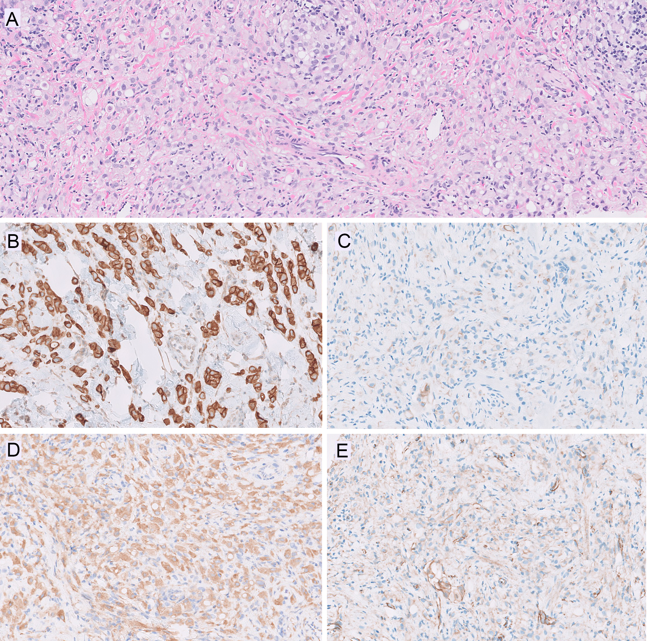 分子时代的乳腺小叶性病变再学习（三）
