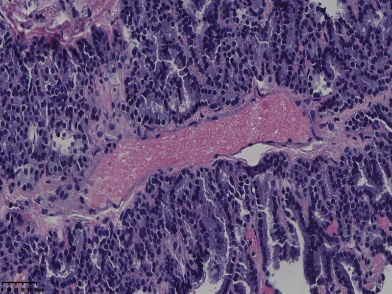 这个甲状腺肿瘤怎么看？